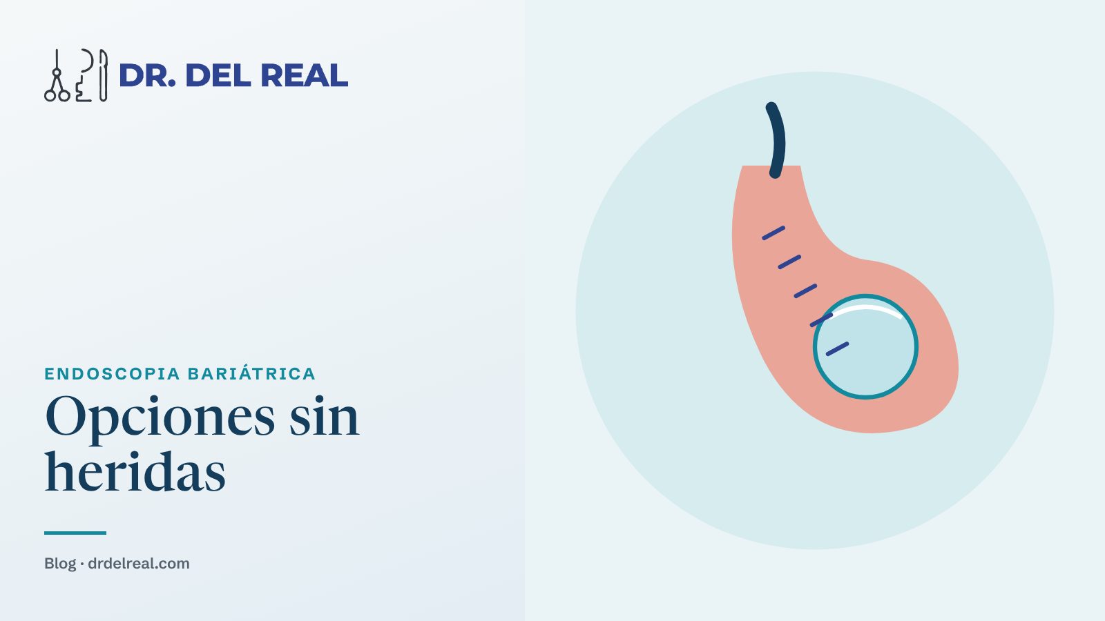 Opciones endoscópicas para la obesidad