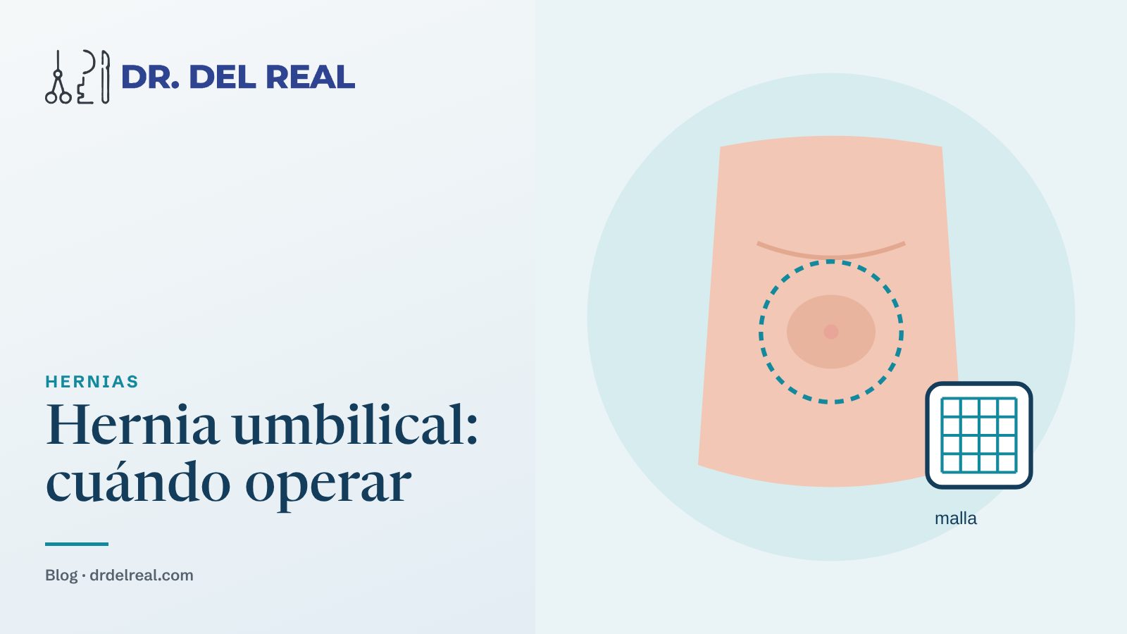 Hernia umbilical: cuándo conviene operar y cuándo se puede esperar