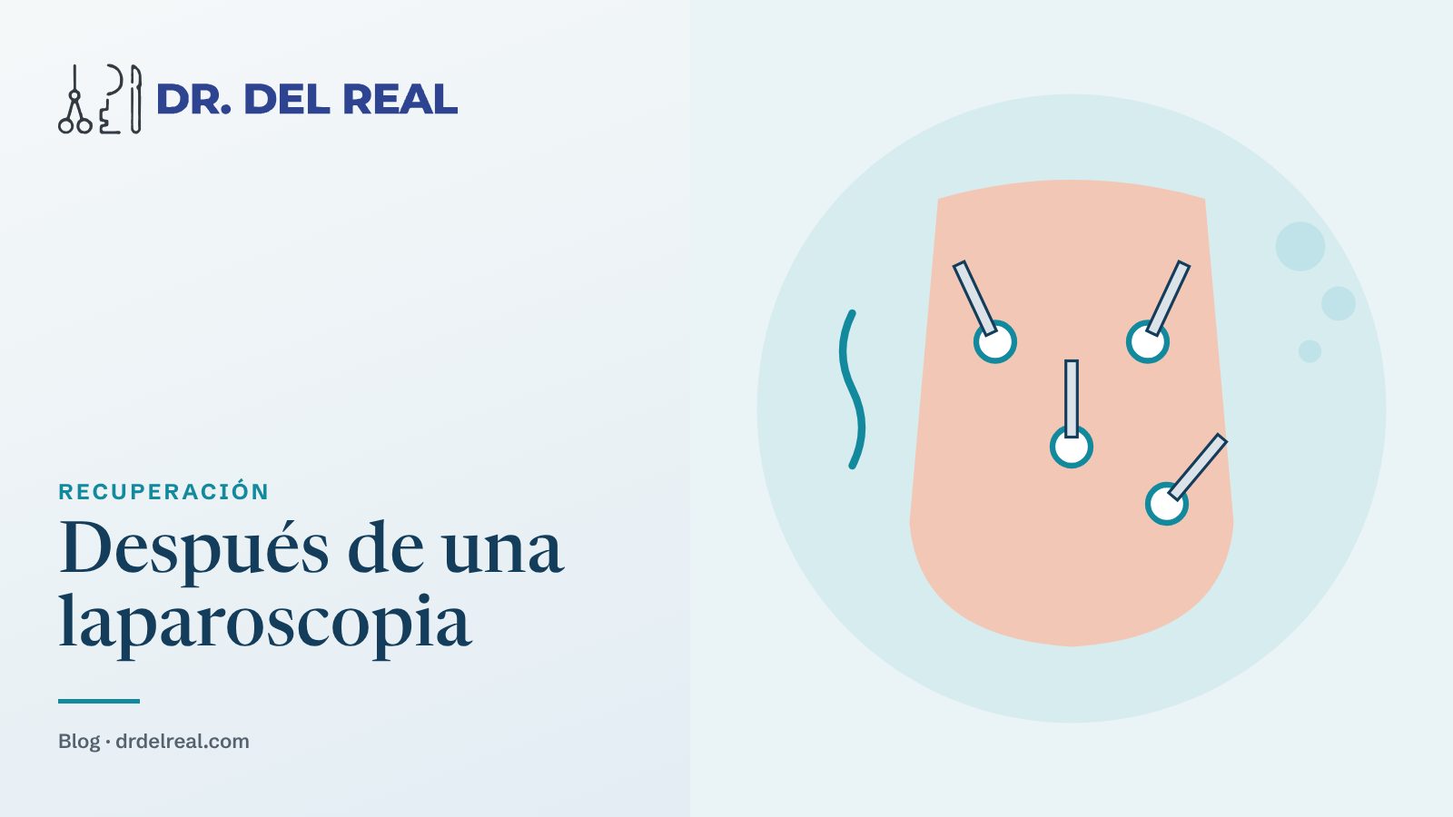 Recuperación después de una laparoscopia: qué esperar los primeros días